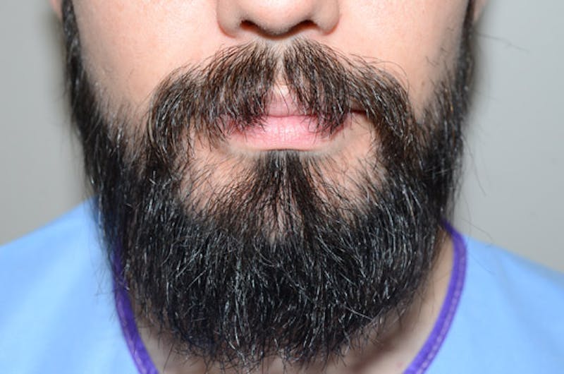 Facial Hair Transplant Before & After Gallery - Patient 977017 - Image 2