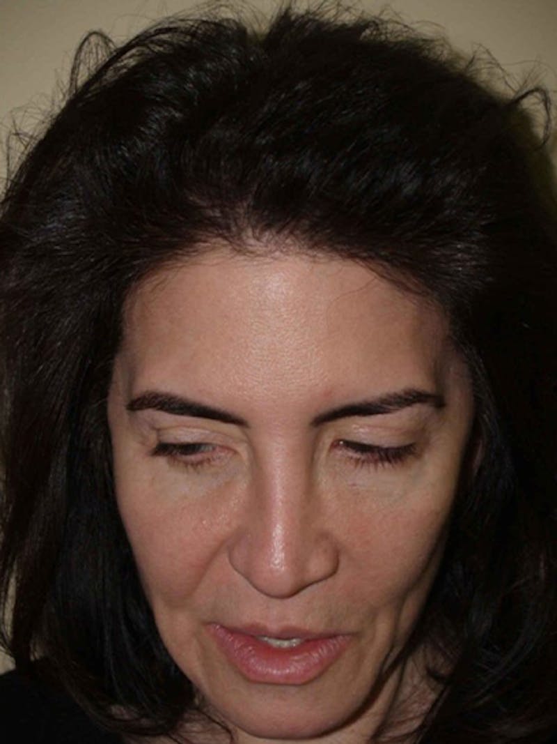 Hair Procedures for Women Before & After Gallery - Patient 403118 - Image 2