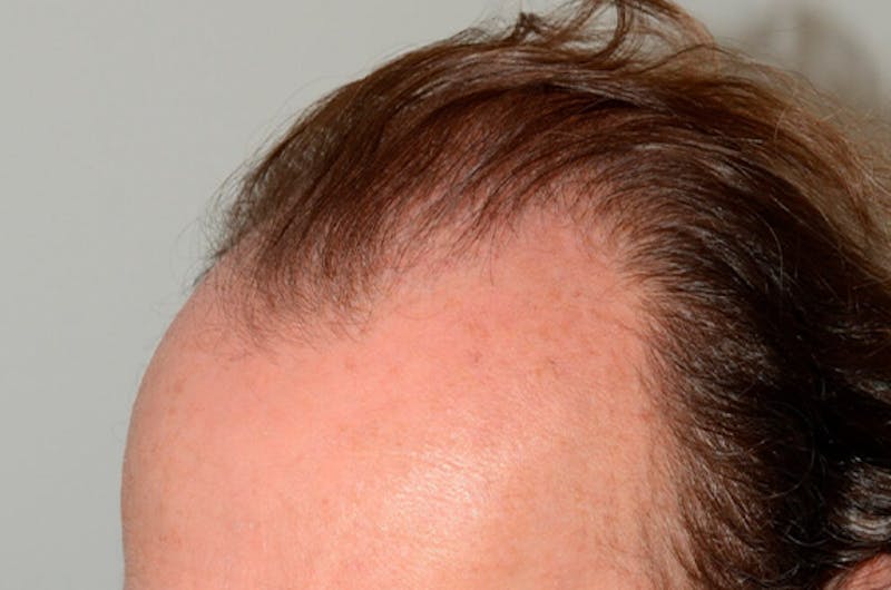 Hair Transplant Repair Before & After Gallery - Patient 206162 - Image 4
