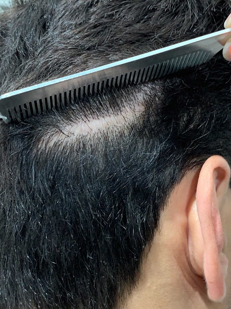 Scalp Micropigmentation Procedures Before & After Gallery - Patient 963696 - Image 3