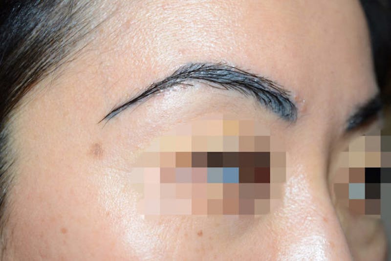 Eyebrow Transplantation Before & After Gallery - Patient 340196 - Image 6