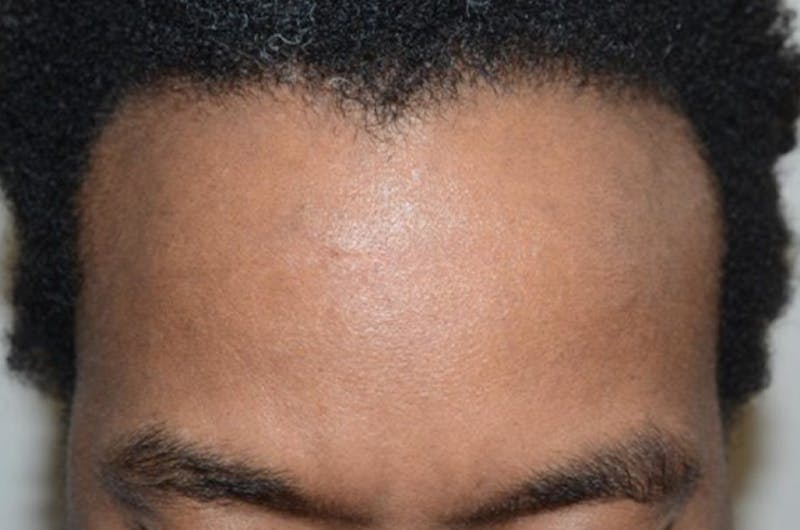 Hair Restoration for Men Before & After Gallery - Patient 302249 - Image 1