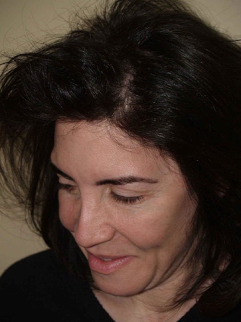 Hair Procedures for Women Before & After Gallery - Patient 403118 - Image 4