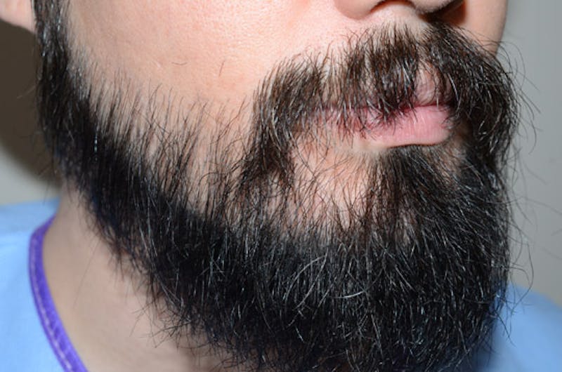 Facial Hair Transplant Before & After Gallery - Patient 977017 - Image 4