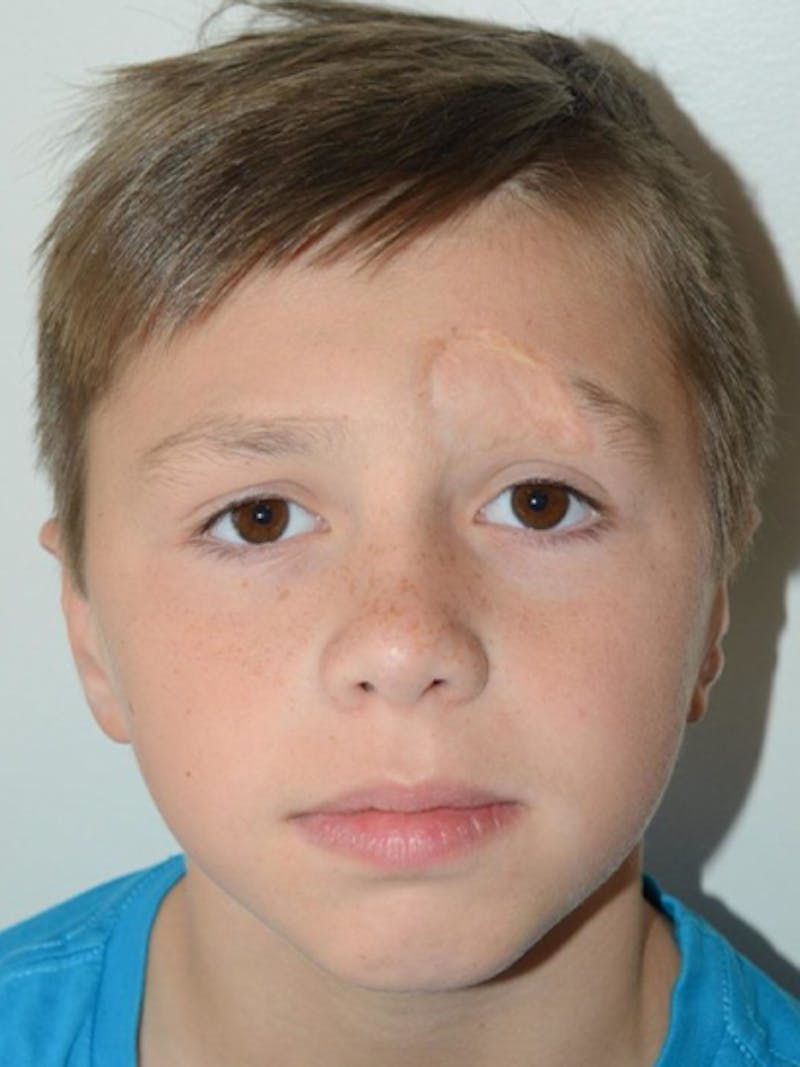 Eyebrow Transplantation Before & After Gallery - Patient 382048 - Image 1