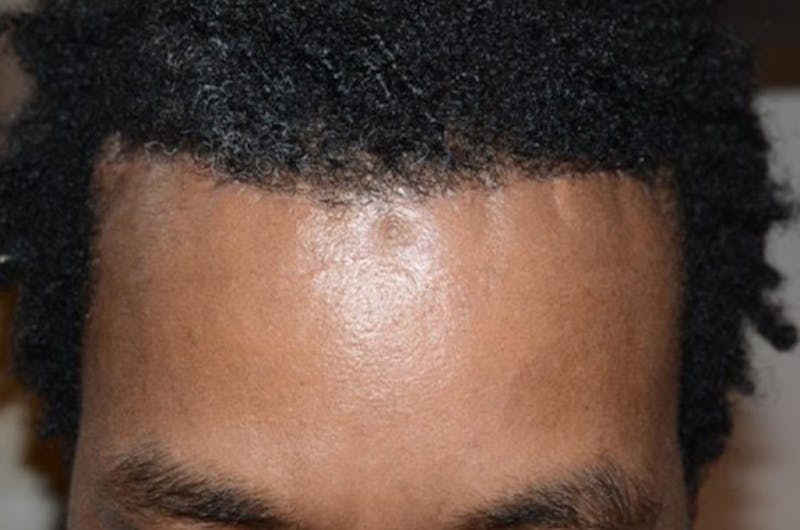 Hair Restoration for Men Before & After Gallery - Patient 302249 - Image 2