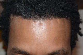 Hairline Lowering Surgery Before & After Gallery - Patient 204255 - Image 2