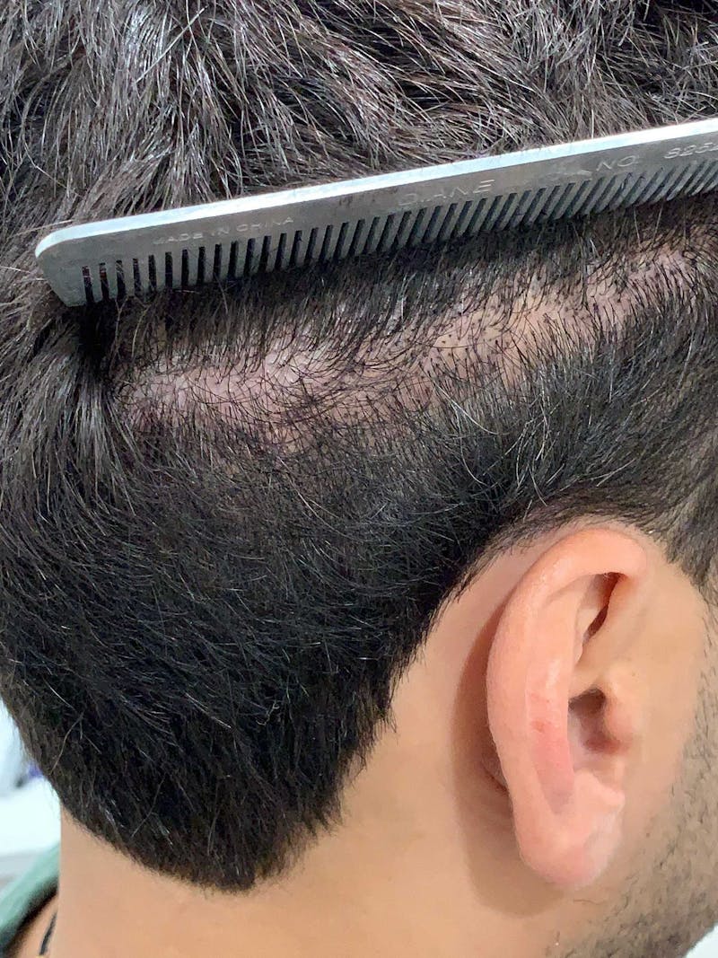 Scalp Micropigmentation Procedures Before & After Gallery - Patient 963696 - Image 4