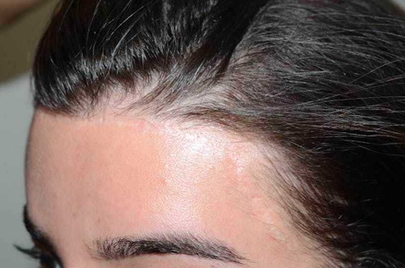 Hair for Gender Reaffirmation Before & After Gallery - Patient 616727 - Image 3