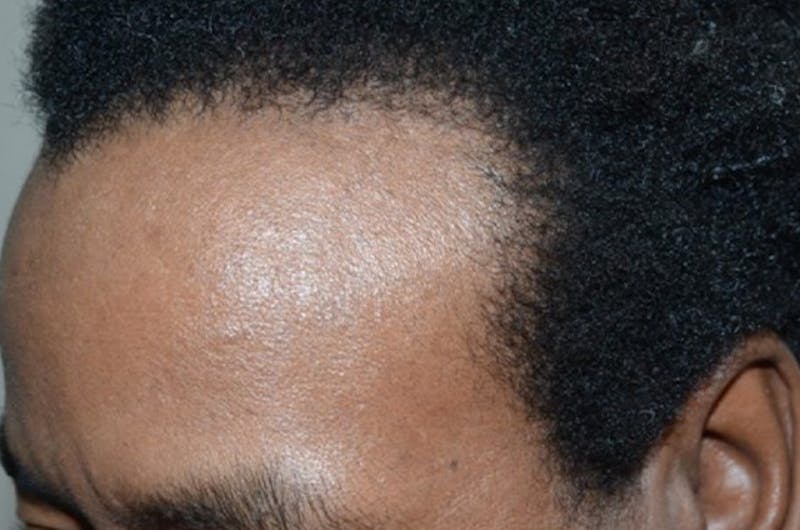 Hair Restoration for Men Before & After Gallery - Patient 302249 - Image 3