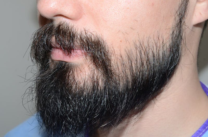 Facial Hair Transplant Before & After Gallery - Patient 977017 - Image 6