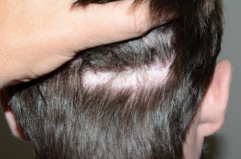 Scalp Micropigmentation Procedures Before & After Gallery - Patient 233387 - Image 1