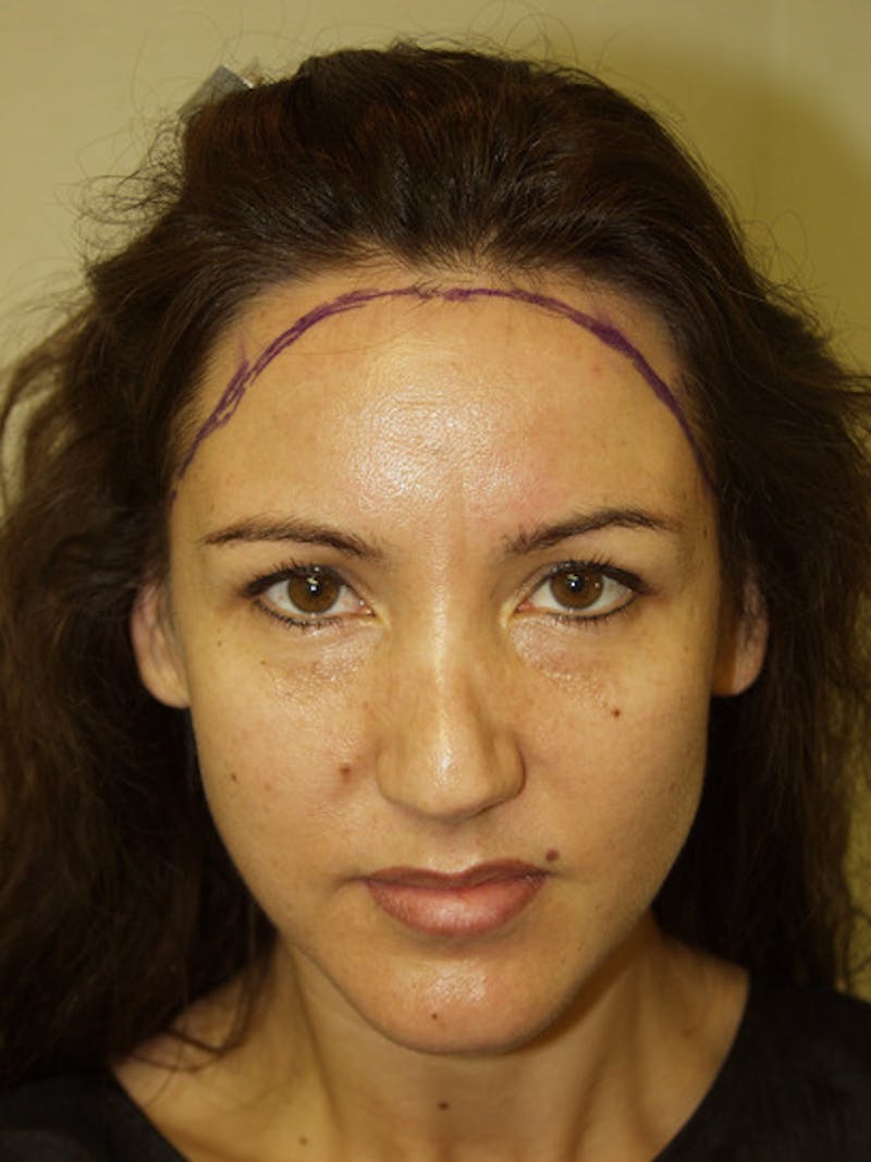 Hair Procedures for Women Before & After Gallery - Patient 102786 - Image 1