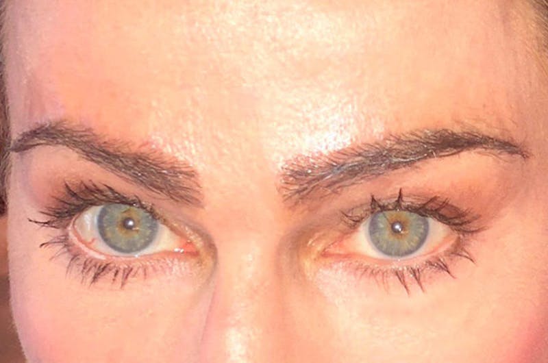 Eyebrow Transplantation Before & After Gallery - Patient 509179 - Image 2