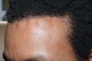 Hairline Lowering Surgery Before & After Gallery - Patient 204255 - Image 4