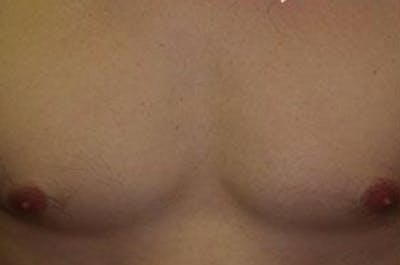 Body Hair Transplants Before & After Gallery - Patient 236325 - Image 1