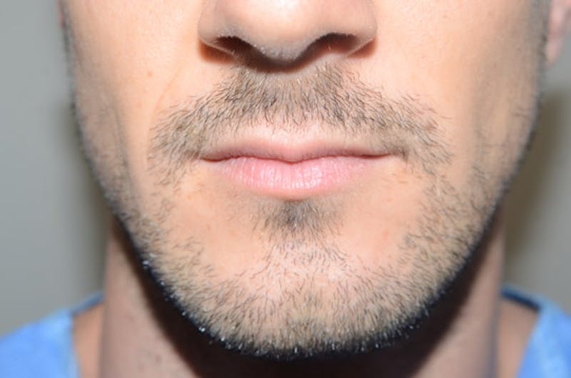 Facial Hair Transplant Before & After Gallery - Patient 116066 - Image 1