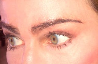 Eyebrow Transplantation Before & After Gallery - Patient 509179 - Image 4