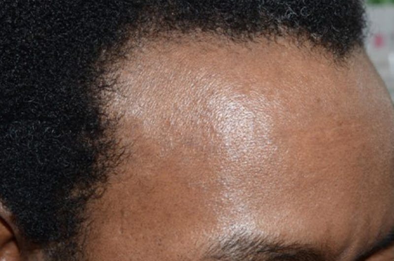 Hair Restoration for Men Before & After Gallery - Patient 302249 - Image 5