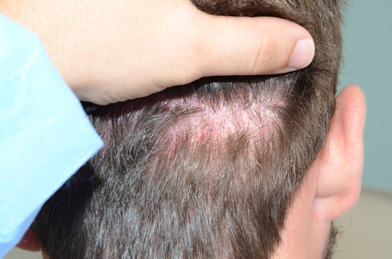 Scalp Micropigmentation Procedures Before & After Gallery - Patient 233387 - Image 2