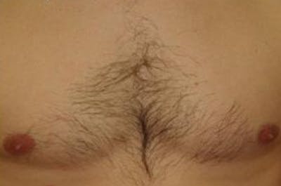 Body Hair Transplants Before & After Gallery - Patient 236325 - Image 2