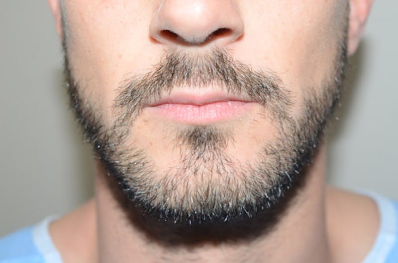 Facial Hair Transplant Before & After Gallery - Patient 116066 - Image 2
