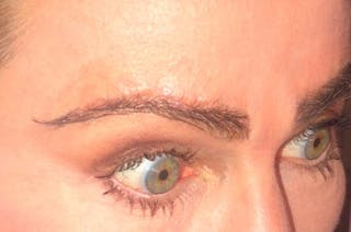 Eyebrow Transplantation Before & After Gallery - Patient 509179 - Image 6