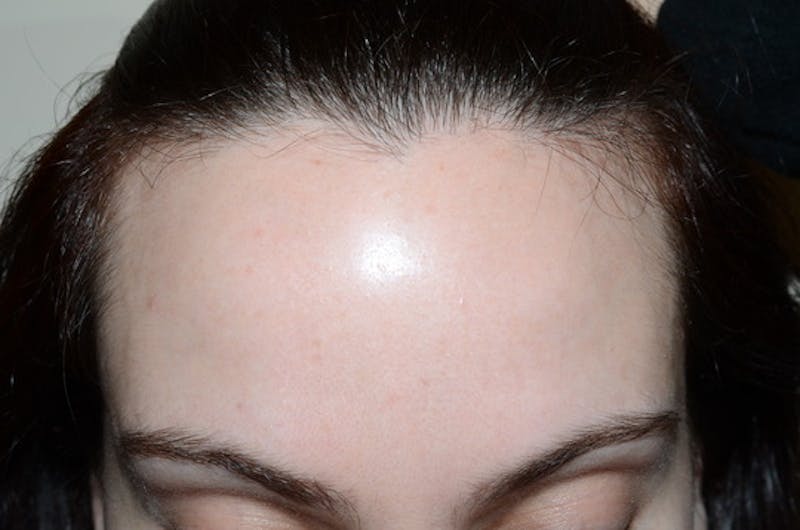 Hair Procedures for Women Before & After Gallery - Patient 346165 - Image 1