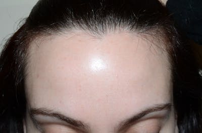 Hair Procedures for Women Before & After Gallery - Patient 663637 - Image 1