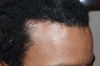 Hairline Lowering Surgery Before & After Gallery - Patient 204255 - Image 6