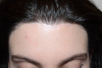 Hair Procedures for Women Before & After Gallery - Patient 663637 - Image 2