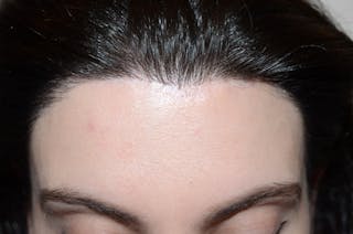 Hair Procedures for Women Before & After Gallery - Patient 346165 - Image 2
