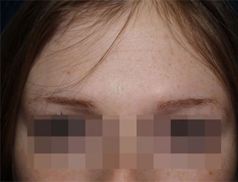 Eyebrow Transplantation Before & After Gallery - Patient 386696 - Image 1