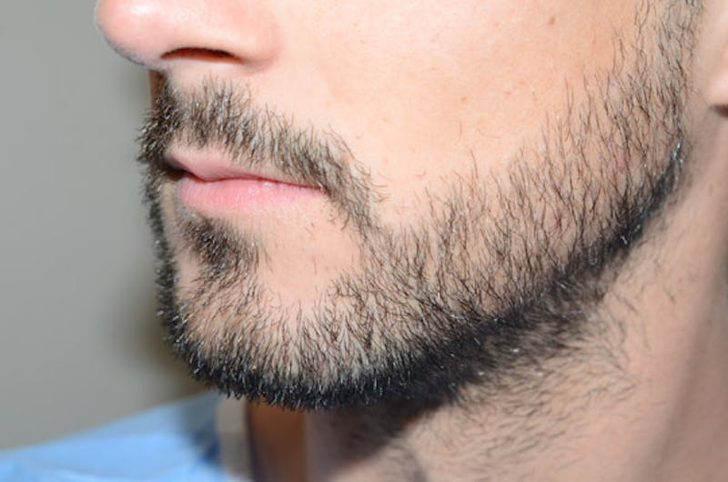 Facial Hair Transplant Before & After Gallery - Patient 116066 - Image 4