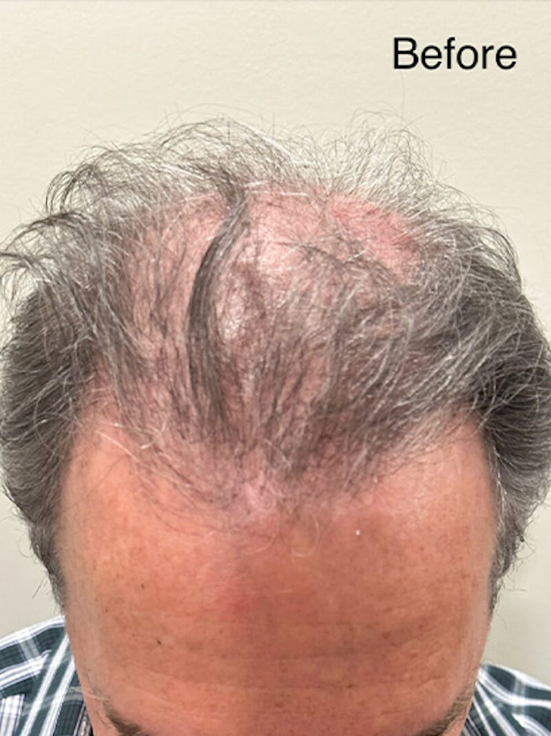 Scalp Micropigmentation Procedures Before & After Gallery - Patient 195953 - Image 1