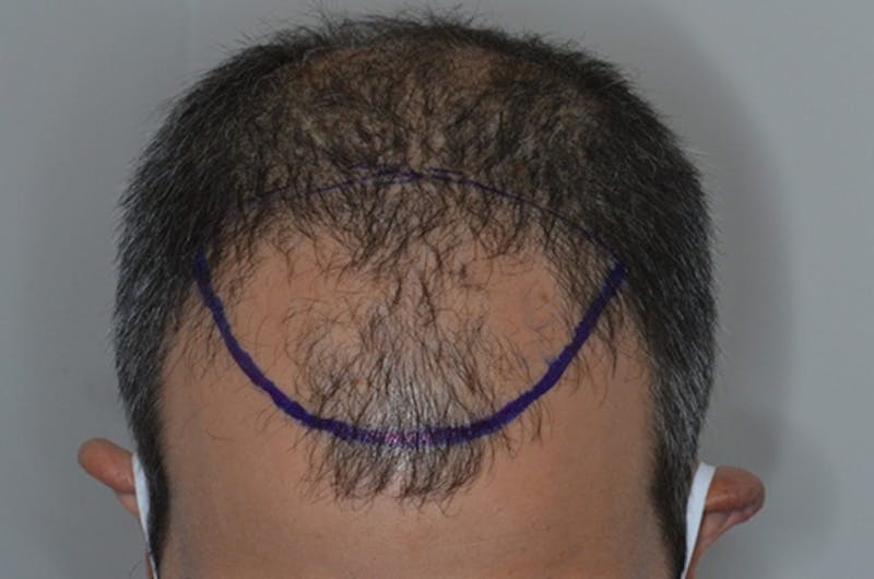 Hair Restoration for Men Before & After Gallery - Patient 146369 - Image 1