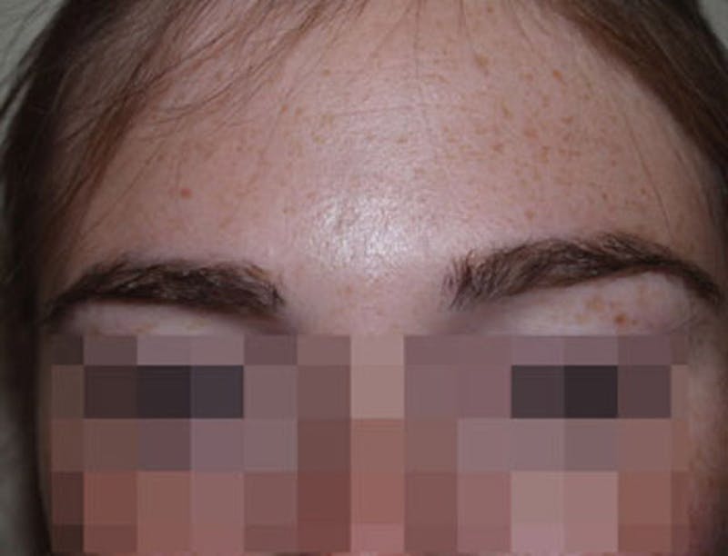 Eyebrow Transplantation Before & After Gallery - Patient 386696 - Image 2