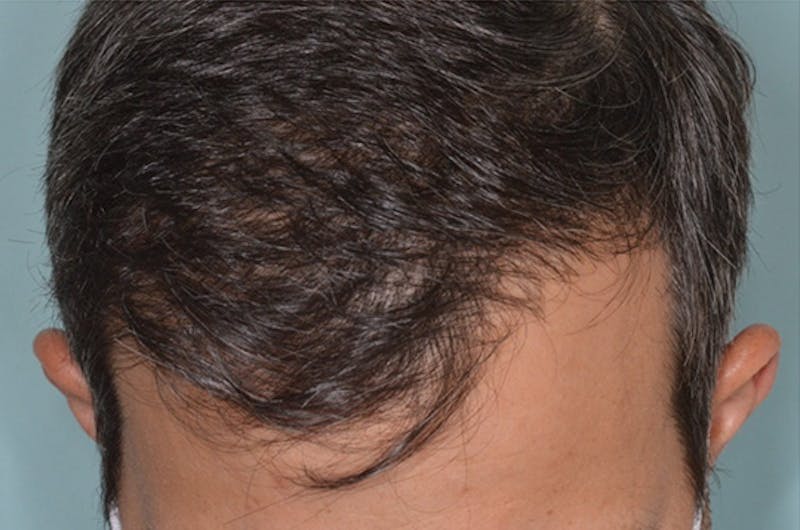 Hair Restoration for Men Before & After Gallery - Patient 146369 - Image 2