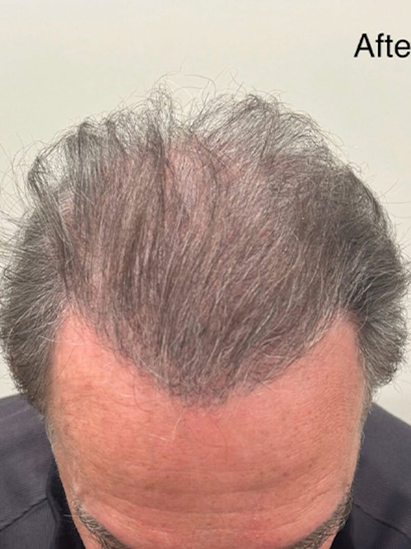 Scalp Micropigmentation Procedures Before & After Gallery - Patient 195953 - Image 2