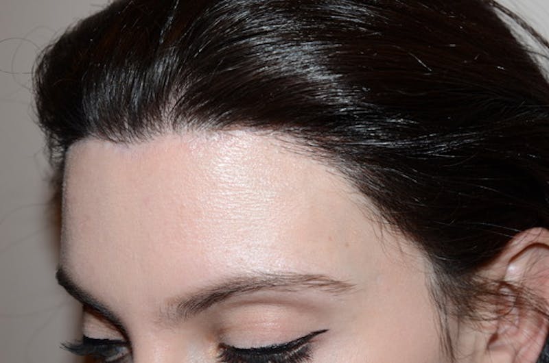 Hair Procedures for Women Before & After Gallery - Patient 346165 - Image 4
