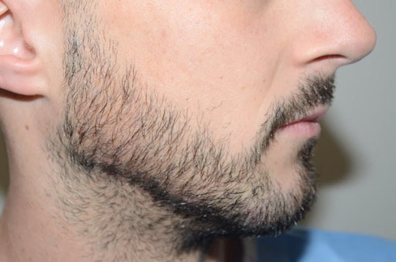 Facial Hair Transplant Before & After Gallery - Patient 116066 - Image 6