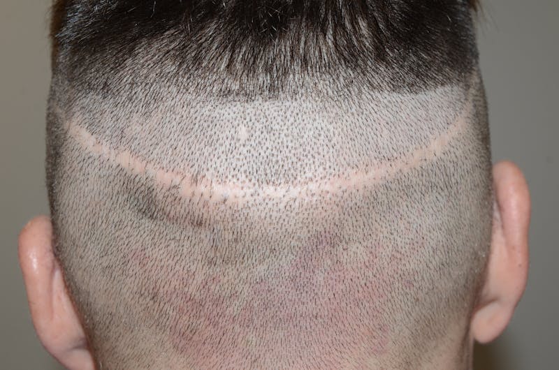 Scalp Micropigmentation Procedures Before & After Gallery - Patient 109773 - Image 1
