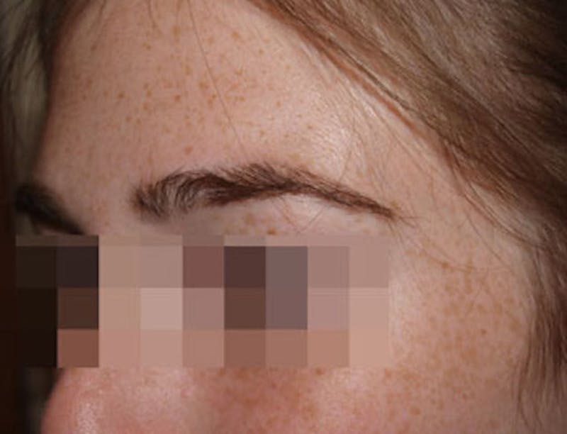 Eyebrow Transplantation Before & After Gallery - Patient 386696 - Image 4