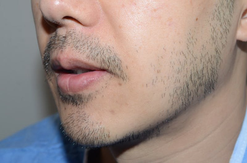 Facial Hair Transplant Before & After Gallery - Patient 565776 - Image 1