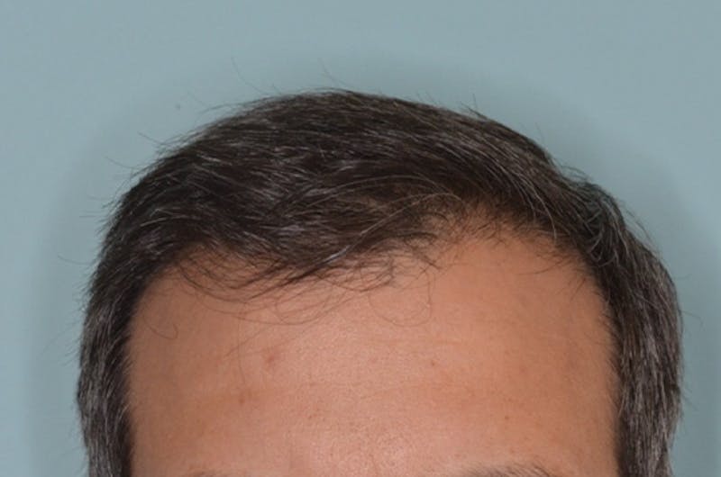 Hair Restoration for Men Before & After Gallery - Patient 146369 - Image 4