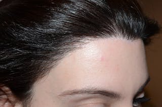 Hair Procedures for Women Before & After Gallery - Patient 346165 - Image 6