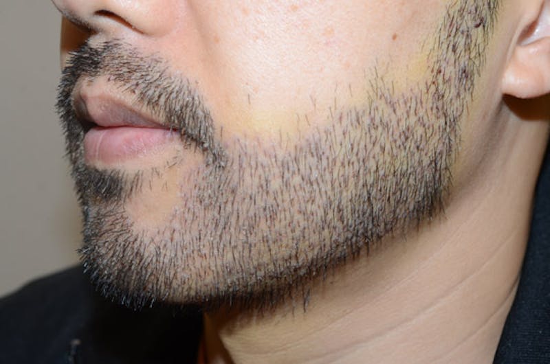 Facial Hair Transplant Before & After Gallery - Patient 565776 - Image 2