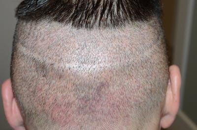 SMP Procedures Before & After Gallery - Patient 349144 - Image 2