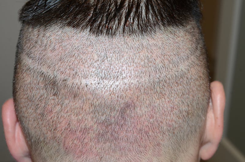 Scalp Micropigmentation Procedures Before & After Gallery - Patient 109773 - Image 2