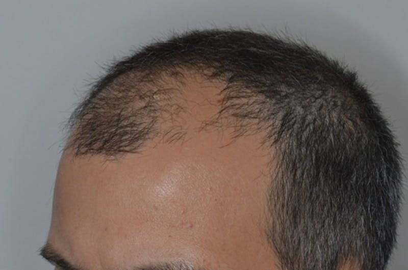 Hair Restoration for Men Before & After Gallery - Patient 146369 - Image 5